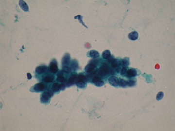 （已公布）山东省细胞病理学会议病例17图3