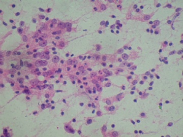 (已公布)山东省细胞病理学会议病例19图1