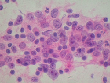(已公布)山东省细胞病理学会议病例19图2