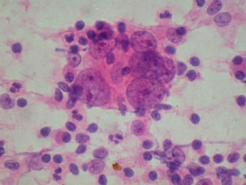 (已公布)山东省细胞病理学会议病例19图3