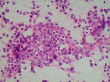 (已公布)山东省细胞病理学会议病例19图4