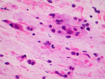 （已公布）山东省细胞病理学会议病例20图1