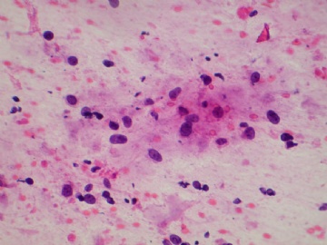 （已公布）山东省细胞病理学会议病例20图3