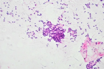 （已公布）山东省细胞病理学会议病例37图2