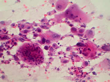 （已公布）山东省细胞病理学会议病例49图4