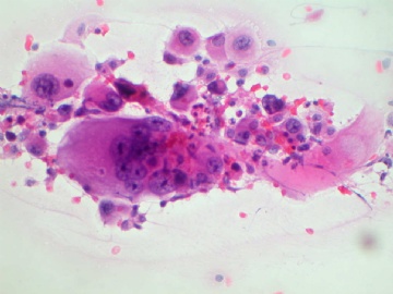 （已公布）山东省细胞病理学会议病例49图5