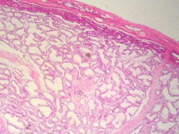经典病例学习-乳腺泌乳性腺瘤图1