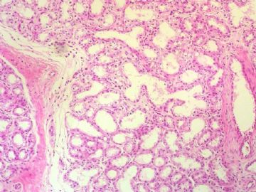 经典病例学习-乳腺泌乳性腺瘤图2