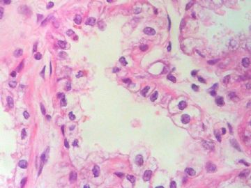 经典病例学习-乳腺泌乳性腺瘤图11