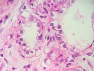 经典病例学习-乳腺泌乳性腺瘤图12