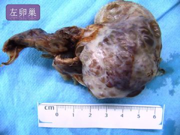 双侧卵巢囊实性肿瘤，大网膜有转移结节。图2