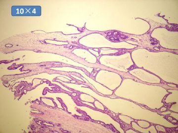 双侧卵巢囊实性肿瘤，大网膜有转移结节。图11