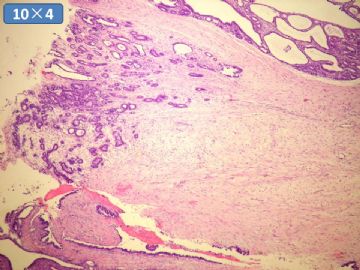 双侧卵巢囊实性肿瘤，大网膜有转移结节。图12
