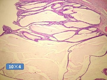 双侧卵巢囊实性肿瘤，大网膜有转移结节。图14