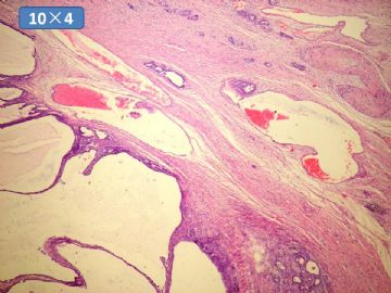 双侧卵巢囊实性肿瘤，大网膜有转移结节。图15