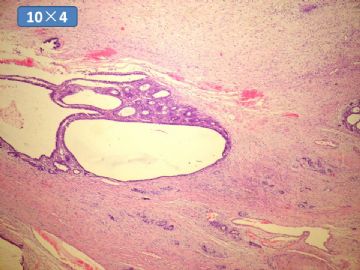 双侧卵巢囊实性肿瘤，大网膜有转移结节。图16