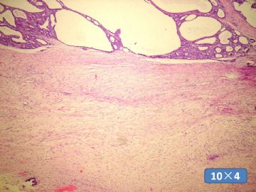 双侧卵巢囊实性肿瘤，大网膜有转移结节。图17