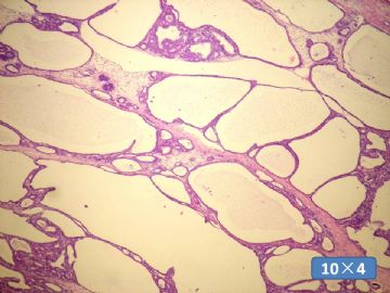 双侧卵巢囊实性肿瘤，大网膜有转移结节。图18