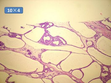 双侧卵巢囊实性肿瘤，大网膜有转移结节。图19