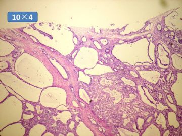 双侧卵巢囊实性肿瘤，大网膜有转移结节。图20