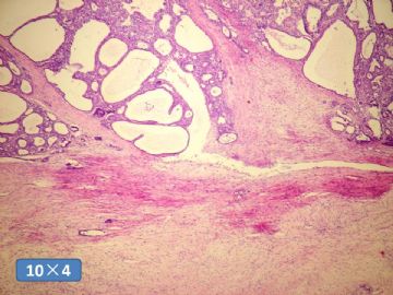 双侧卵巢囊实性肿瘤，大网膜有转移结节。图21