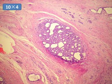 双侧卵巢囊实性肿瘤，大网膜有转移结节。图23