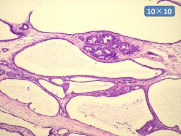 双侧卵巢囊实性肿瘤，大网膜有转移结节。图25