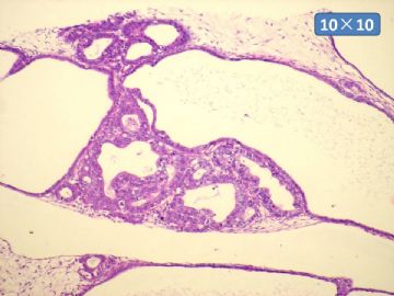 双侧卵巢囊实性肿瘤，大网膜有转移结节。图26