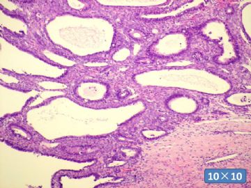 双侧卵巢囊实性肿瘤，大网膜有转移结节。图29