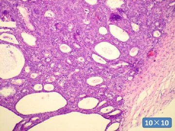 双侧卵巢囊实性肿瘤，大网膜有转移结节。图30