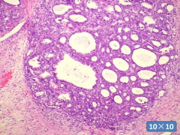 双侧卵巢囊实性肿瘤，大网膜有转移结节。图31