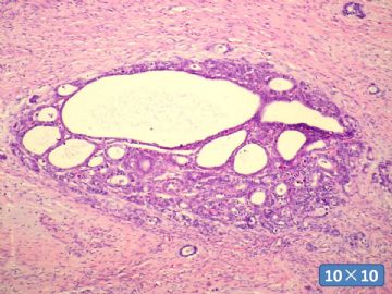 双侧卵巢囊实性肿瘤，大网膜有转移结节。图32