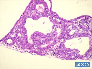 双侧卵巢囊实性肿瘤，大网膜有转移结节。图33