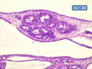 双侧卵巢囊实性肿瘤，大网膜有转移结节。图34