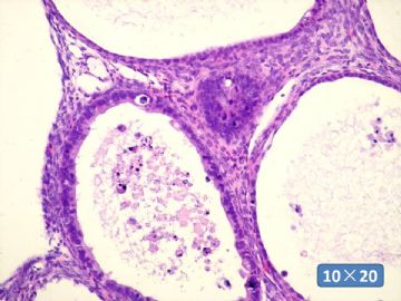 双侧卵巢囊实性肿瘤，大网膜有转移结节。图36