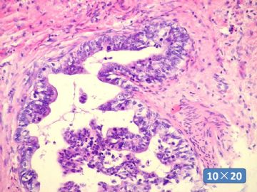 双侧卵巢囊实性肿瘤，大网膜有转移结节。图37