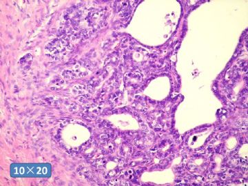 双侧卵巢囊实性肿瘤，大网膜有转移结节。图38