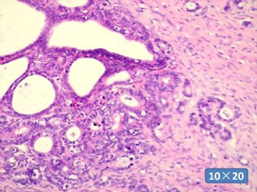 双侧卵巢囊实性肿瘤，大网膜有转移结节。图39