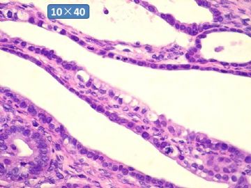 双侧卵巢囊实性肿瘤，大网膜有转移结节。图41
