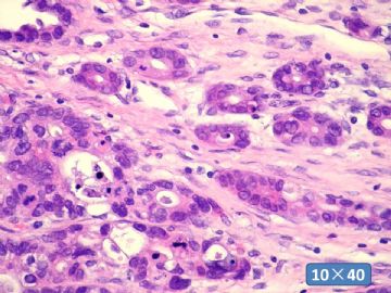 双侧卵巢囊实性肿瘤，大网膜有转移结节。图42