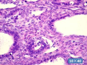 双侧卵巢囊实性肿瘤，大网膜有转移结节。图43