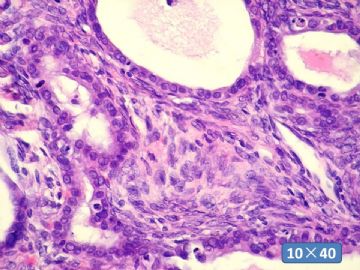 双侧卵巢囊实性肿瘤，大网膜有转移结节。图44