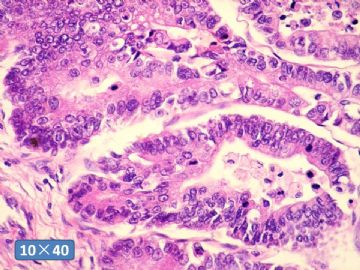 双侧卵巢囊实性肿瘤，大网膜有转移结节。图47