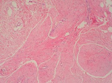 最近的12个病例-7，平滑肌瘤图3