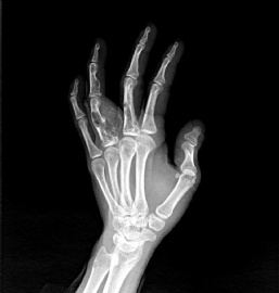 左手环指近节多发性内生性软骨瘤图1
