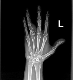 左手环指近节多发性内生性软骨瘤图2