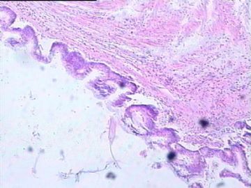 阑尾粘液囊肿？粘液腺瘤？粘液癌？急发报告，请老师帮忙！图5