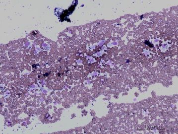 下颌骨肿瘤细胞学检查图1