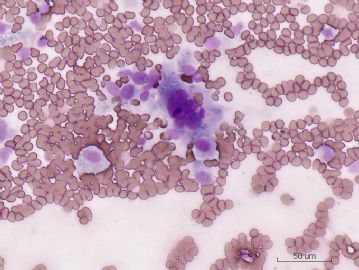 下颌骨肿瘤细胞学检查图9