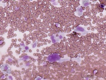 下颌骨肿瘤细胞学检查图10